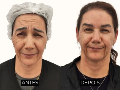 Resultado antes e depois 1